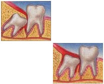 Third Molar Extractions